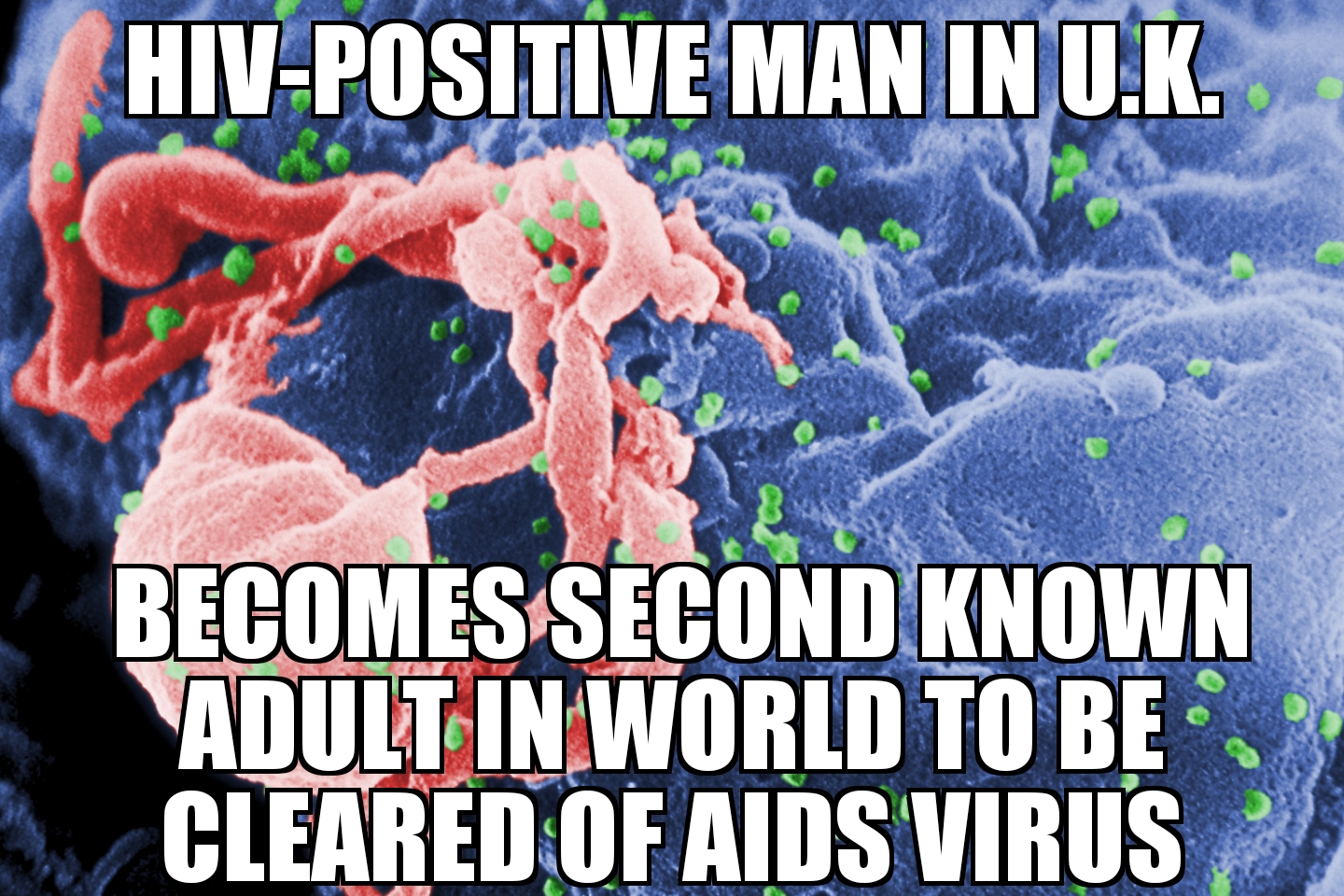 U.K. man cleared of AIDS virus