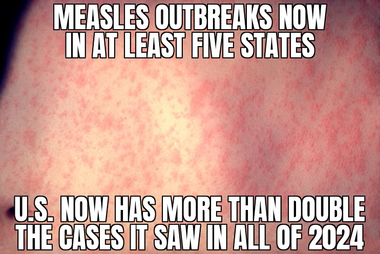 U.S. measles outbreaks
